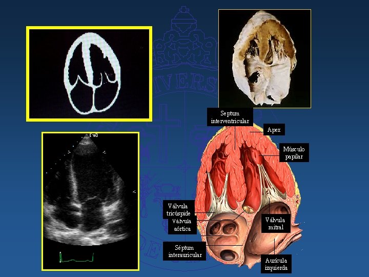 Septum interventricular Apex Músculo papilar Válvula tricúspide Válvula aórtica Séptum interauricular Válvula mitral Aurícula