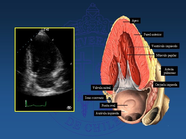 Apex Pared anterior Ventrículo izquierdo Músculo papilar Arteria pulmonar Válvula mitral Seno corovario Fosita
