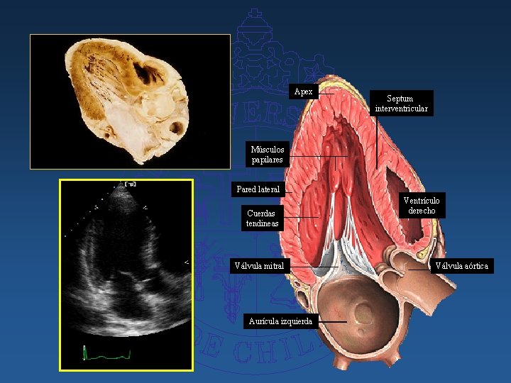Apex Septum interventricular Músculos papilares Pared lateral Cuerdas tendineas Válvula mitral Aurícula izquierda Ventrículo