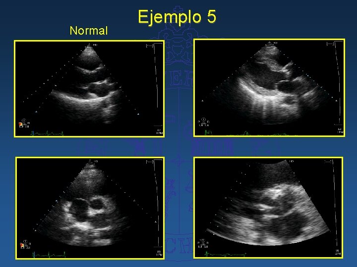 Normal Ejemplo 5 