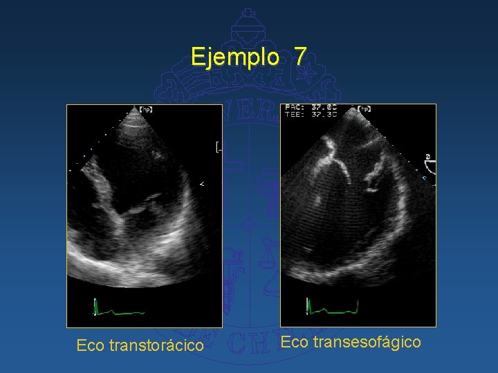 Ejemplo 7 Eco transtorácico Eco transesofágico 
