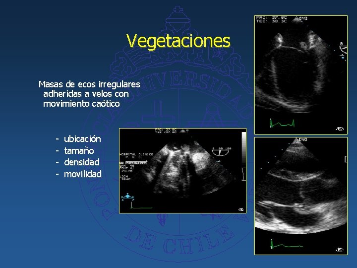 Vegetaciones Masas de ecos irregulares adheridas a velos con movimiento caótico - ubicación tamaño