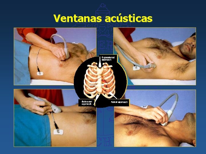 Ventanas acústicas 