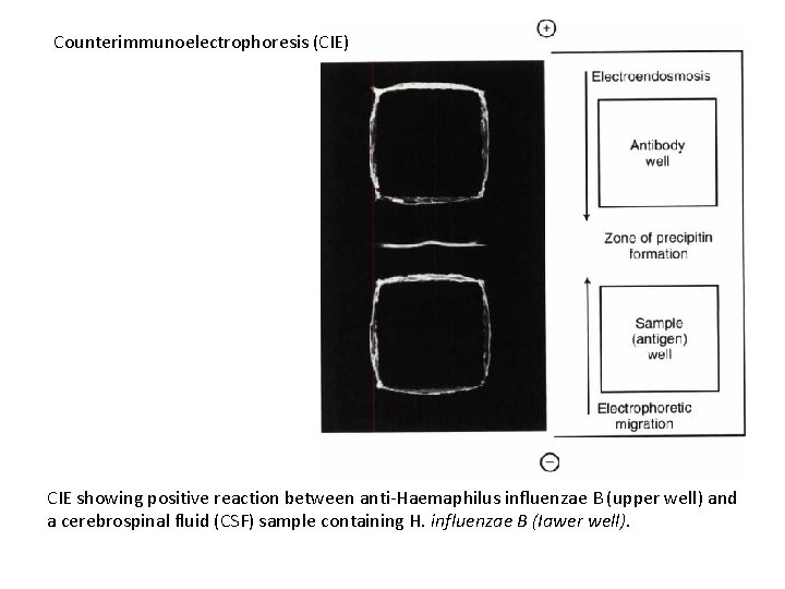 Counterimmunoelectrophoresis (CIE) CIE showing positive reaction between anti-Haemaphilus influenzae B (upper well) and a