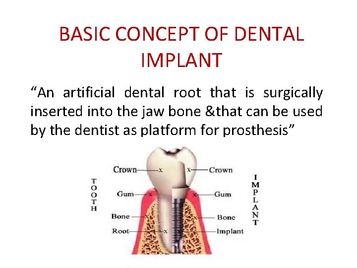 BASIC CONCEPT OF DENTAL IMPLANT “An artificial dental root that is surgically inserted into