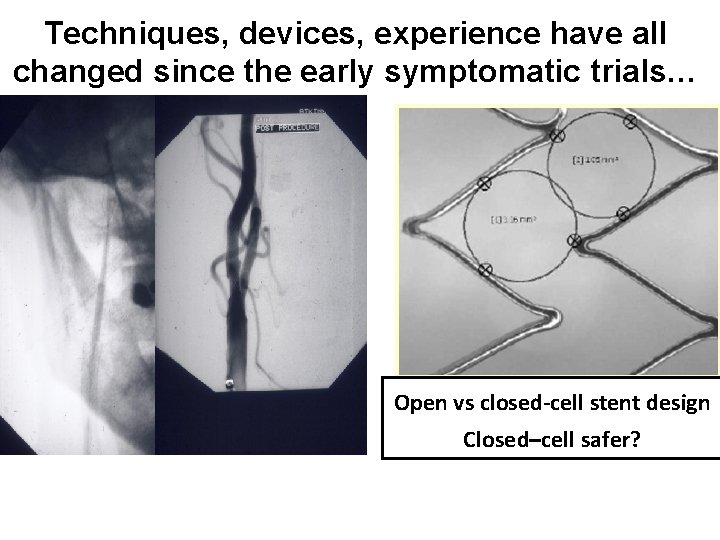 Techniques, devices, experience have all changed since the early symptomatic trials… Open vs closed-cell