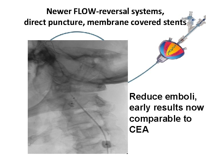 Newer FLOW-reversal systems, direct puncture, membrane covered stents Reduce emboli, early results now comparable