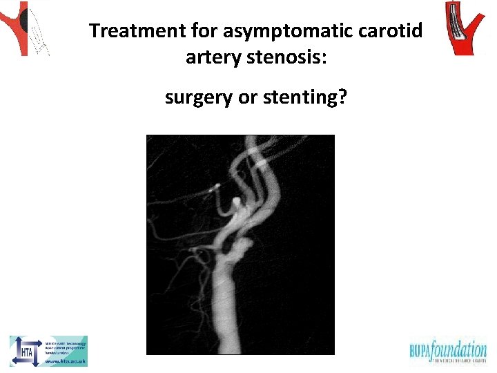 Treatment for asymptomatic carotid artery stenosis: surgery or stenting? 