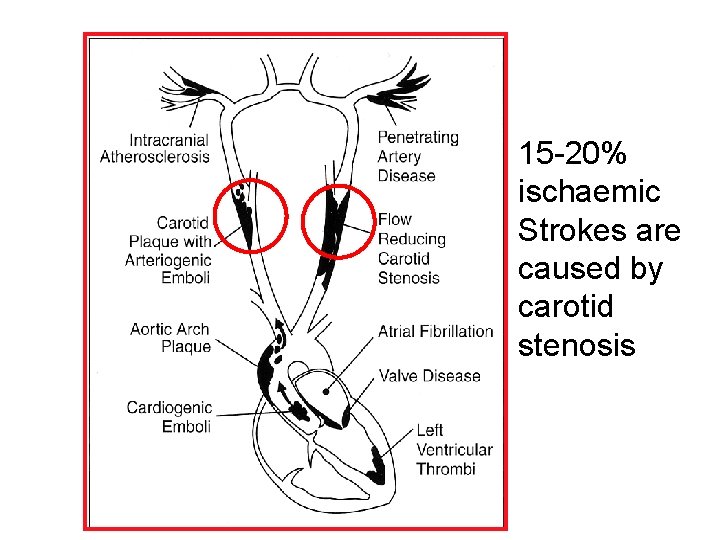 15 -20% ischaemic Strokes are caused by carotid stenosis 