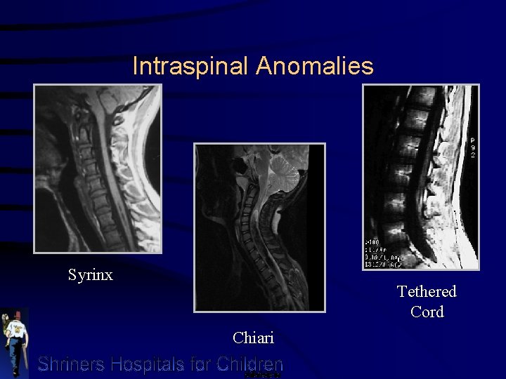 Intraspinal Anomalies Syrinx Tethered Cord Chiari 