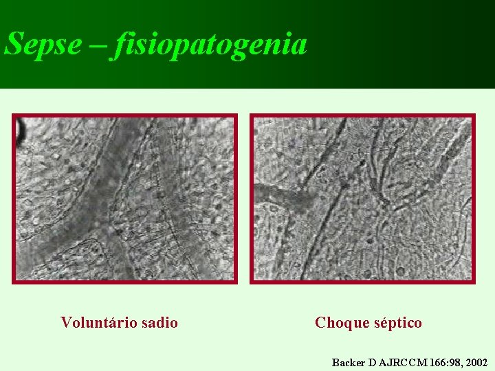 Sepse – fisiopatogenia Voluntário sadio Choque séptico Backer D AJRCCM 166: 98, 2002 