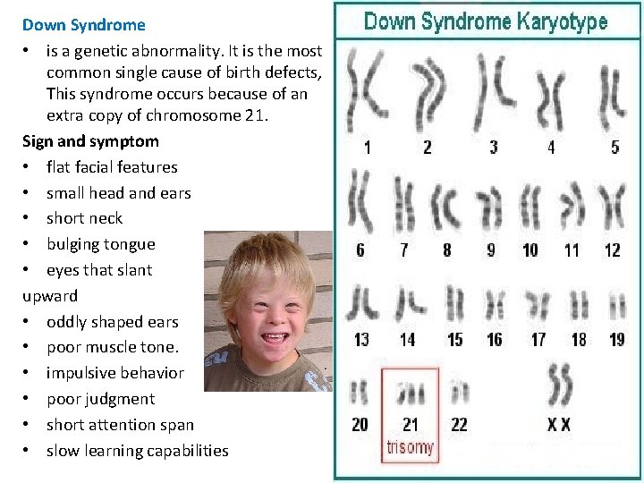 Down Syndrome • is a genetic abnormality. It is the most common single cause