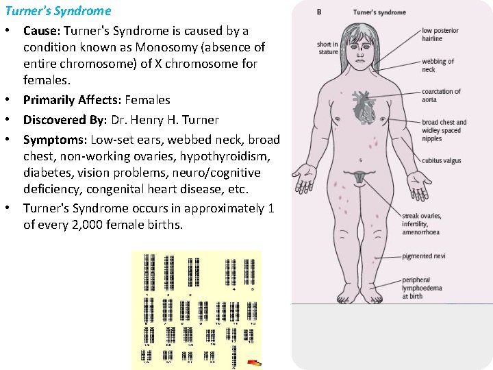 Turner's Syndrome • Cause: Turner's Syndrome is caused by a condition known as Monosomy