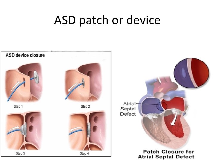 ASD patch or device 28 
