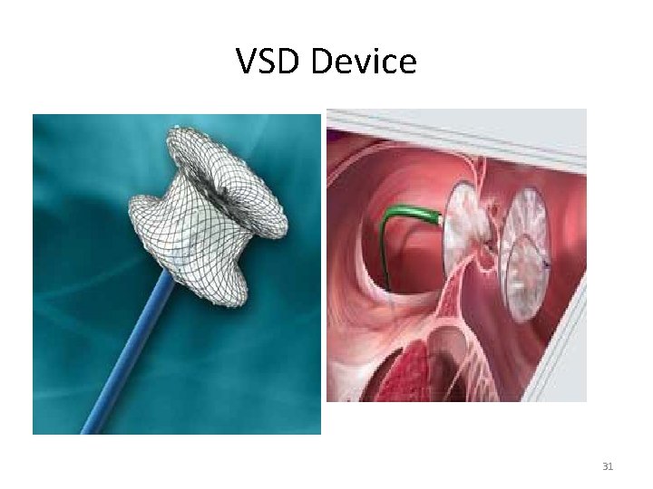 VSD Device 31 