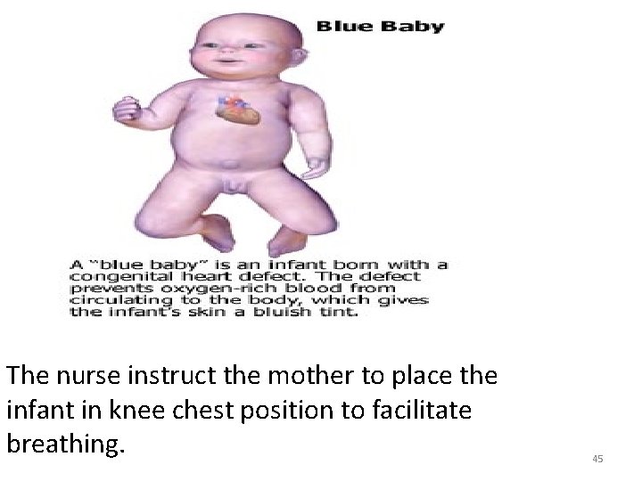 The nurse instruct the mother to place the infant in knee chest position to