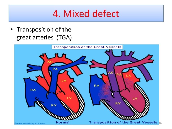 4. Mixed defect • Transposition of the great arteries (TGA) 46 