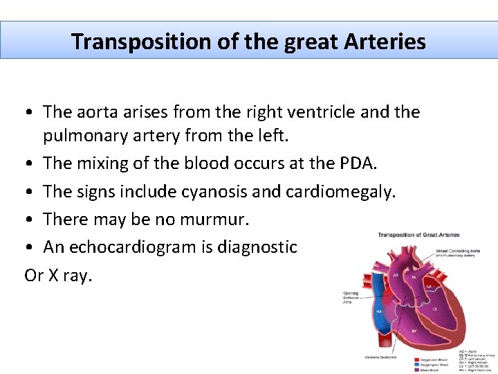 Transposition of the great Arteries • The aorta arises from the right ventricle and