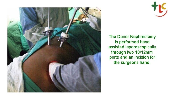 The Donor Nephrectomy is performed hand assisted laparoscopically through two 10/12 mm ports and