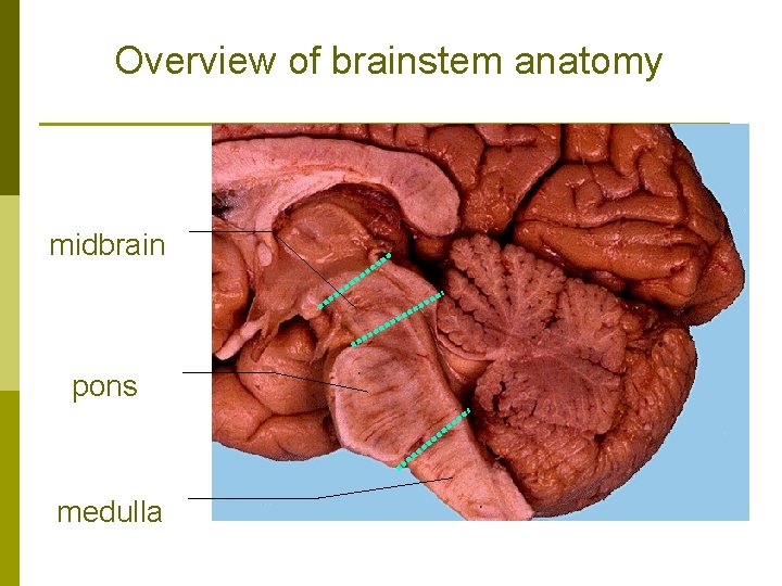 Overview of brainstem anatomy midbrain pons medulla 