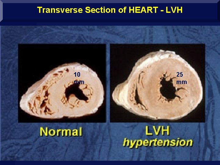 Transverse Section of HEART - LVH 10 mm www. drsarma. in Dr. Sarma@works 25