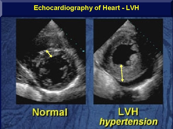 Echocardiography of Heart - LVH www. drsarma. in Dr. Sarma@works 45 