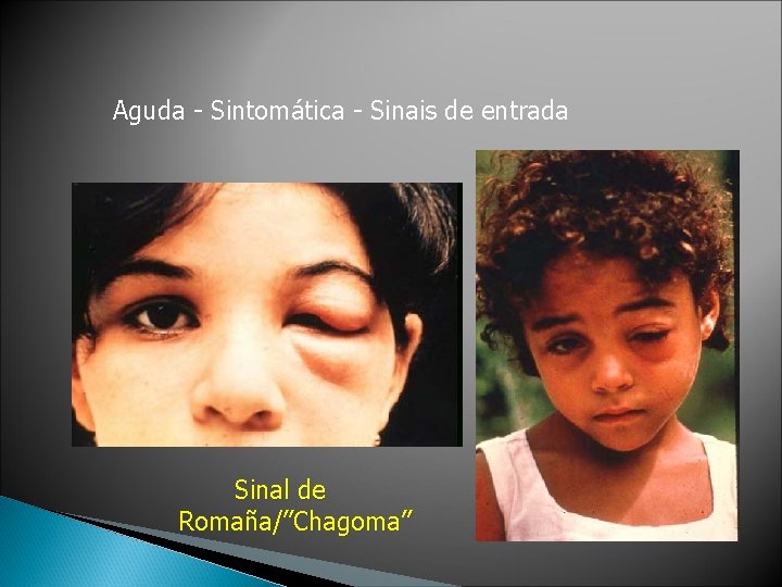 Aguda - Sintomática - Sinais de entrada Sinal de Romaña/”Chagoma” 