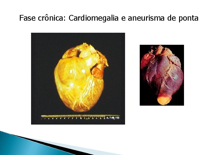 Fase crônica: Cardiomegalia e aneurisma de ponta 