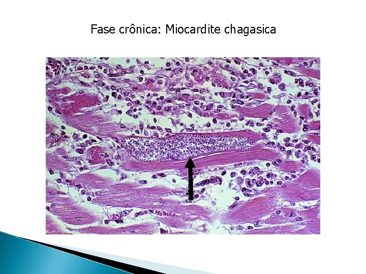 Fase crônica: Miocardite chagasica 