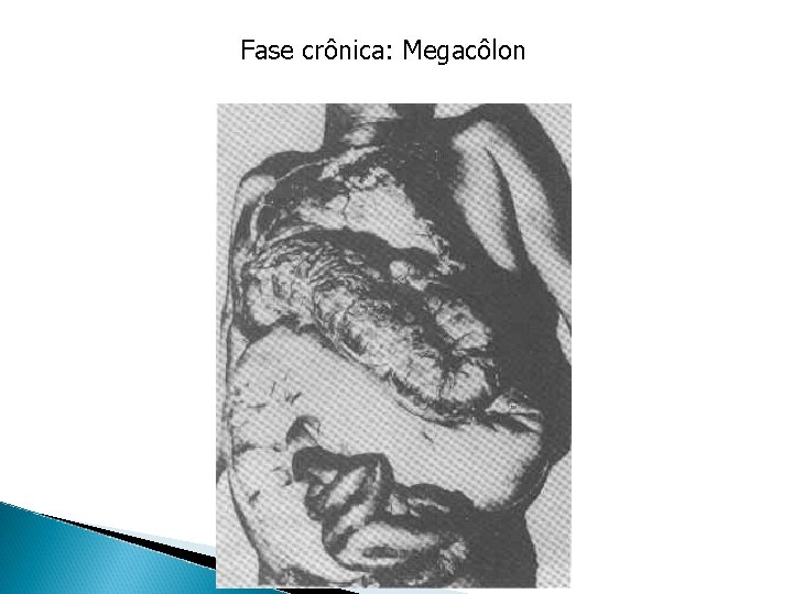 Fase crônica: Megacôlon Fase crônica: Megacôlon