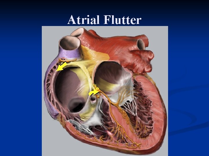 Atrial Flutter Atrial Flutter