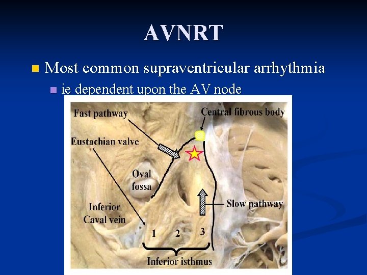 AVNRT n Most common supraventricular arrhythmia n ie dependent upon the AV node AVNRT n Most common supraventricular arrhythmia n ie dependent upon the AV node