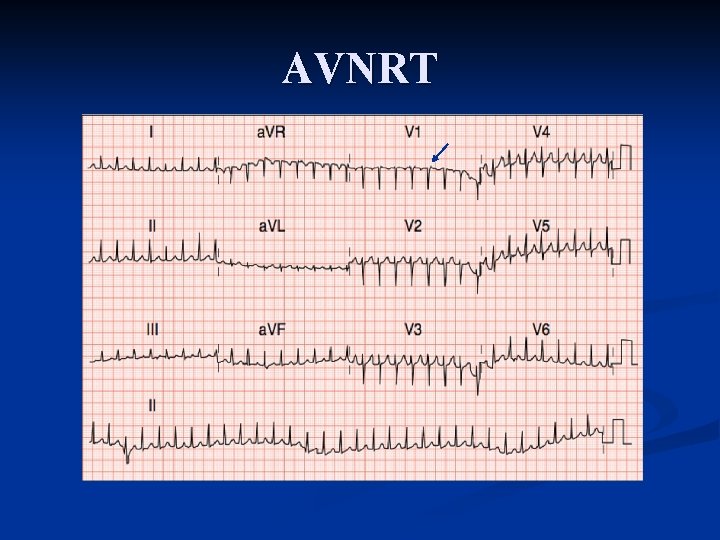 AVNRT AVNRT