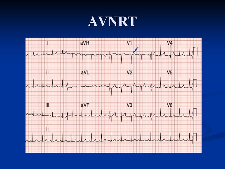 AVNRT AVNRT