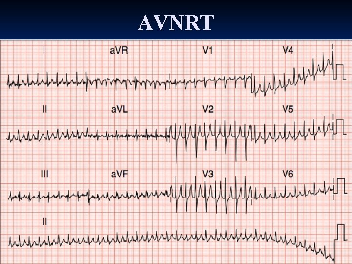 AVNRT AVNRT
