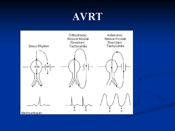 ECG 101 Narrow Complex Tachycardia Scott E Ewing