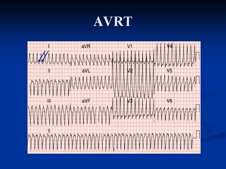 AVRT AVRT