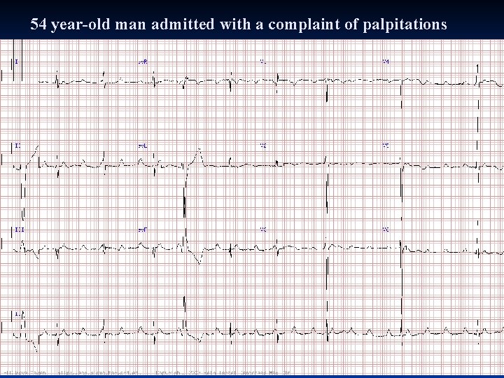 54 year-old man admitted with a complaint of palpitations 54 year-old man admitted with a complaint of palpitations