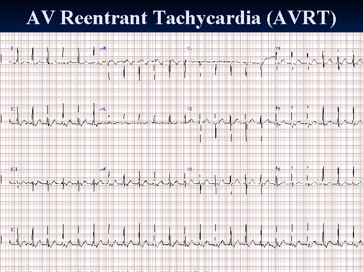 AV Reentrant Tachycardia (AVRT) AV Reentrant Tachycardia (AVRT)