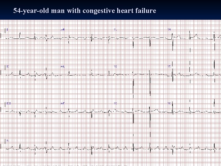 54 -year-old man with congestive heart failure 54 -year-old man with congestive heart failure