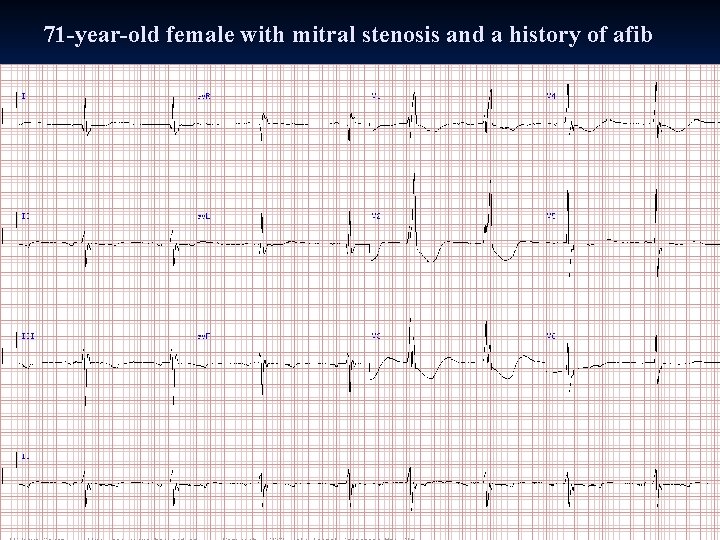 71 -year-old female with mitral stenosis and a history of afib 71 -year-old female with mitral stenosis and a history of afib