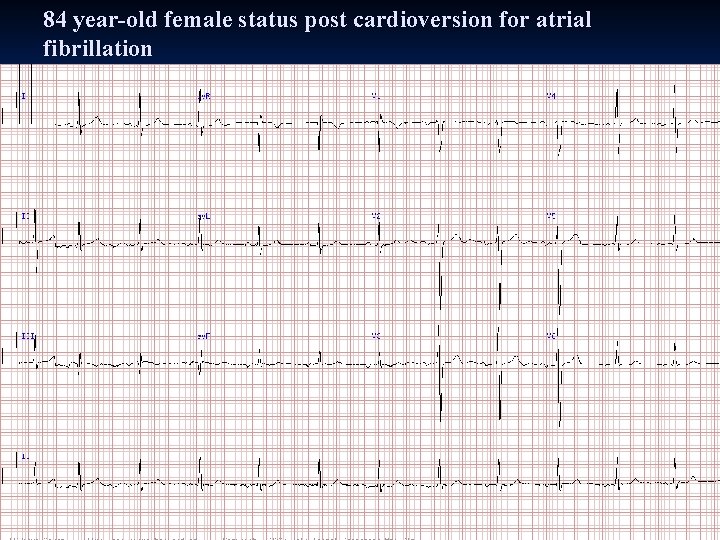 84 year-old female status post cardioversion for atrial fibrillation 84 year-old female status post cardioversion for atrial fibrillation
