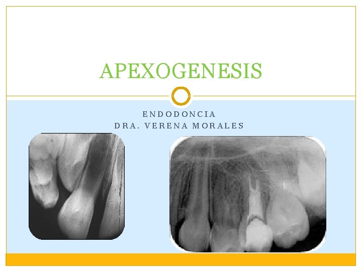APEXOGENESIS ENDODONCIA DRA. VERENA MORALES APEXOGENESIS ENDODONCIA DRA. VERENA MORALES