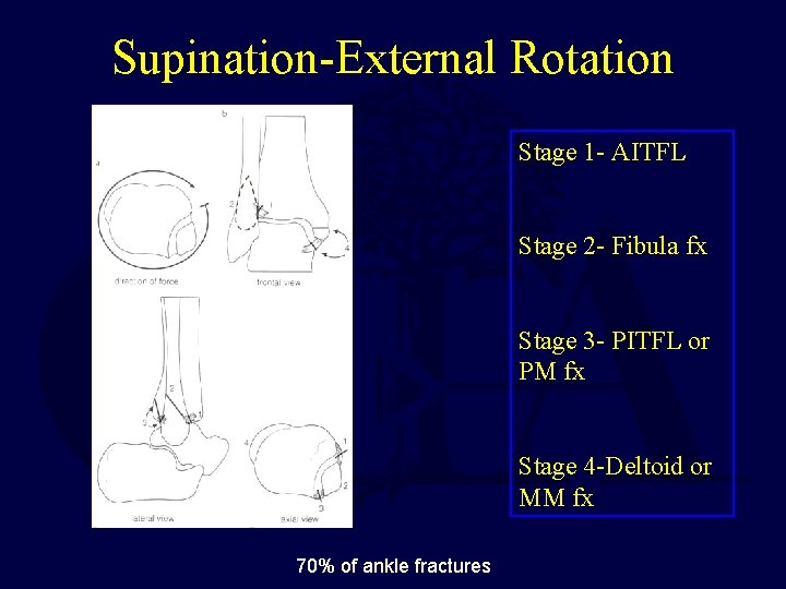 Supination-External Rotation Stage 1 - AITFL Stage 2 - Fibula fx Stage 3 -