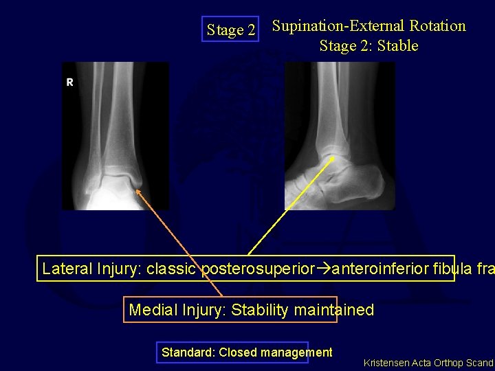 Stage 2 Supination-External Rotation Stage 2: Stable Lateral Injury: classic posterosuperior anteroinferior fibula fra Stage 2 Supination-External Rotation Stage 2: Stable Lateral Injury: classic posterosuperior anteroinferior fibula fra