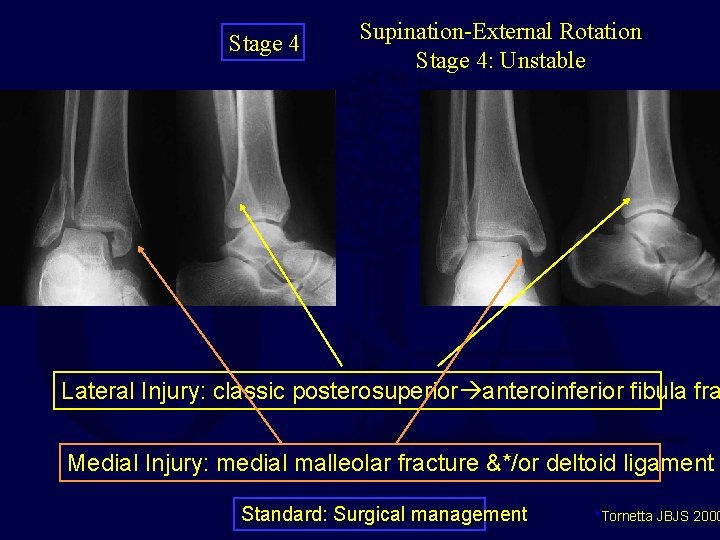 Stage 4 Supination-External Rotation Stage 4: Unstable Lateral Injury: classic posterosuperior anteroinferior fibula fra