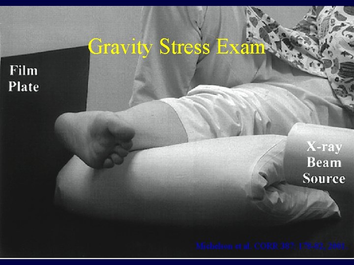 Gravity Stress Exam Michelson et al. CORR 387: 178 -82, 2001. Gravity Stress Exam Michelson et al. CORR 387: 178 -82, 2001.