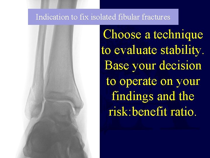 Indication to fix isolated fibular fractures Choose a technique to evaluate stability. Base your Indication to fix isolated fibular fractures Choose a technique to evaluate stability. Base your