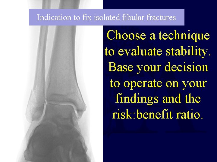 Indication to fix isolated fibular fractures Choose a technique to evaluate stability. Base your