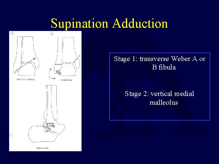 Supination Adduction Stage 1: transverse Weber A or B fibula Stage 2: vertical medial